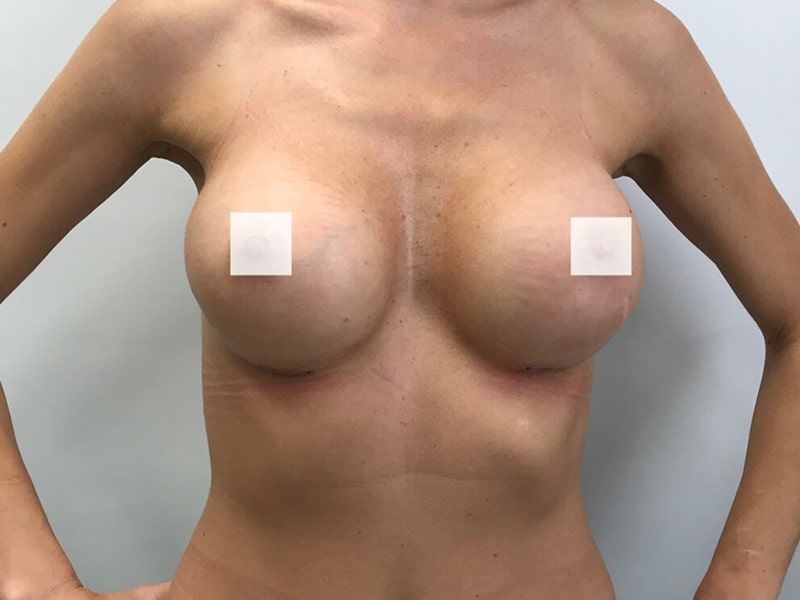 Po zabiegu – implanty anatomiczne