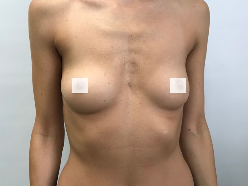 Przed zabiegiem – implanty anatomiczne