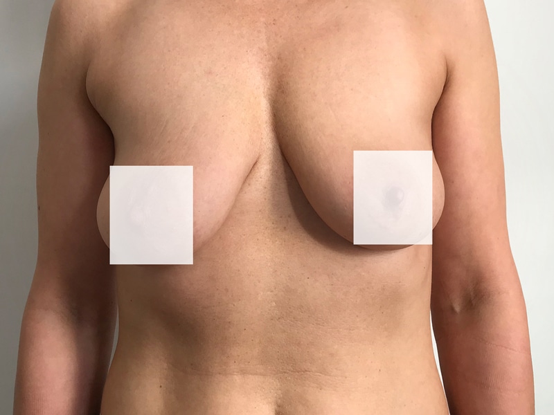 Przed zabiegiem – 230 CC z podniesieniem