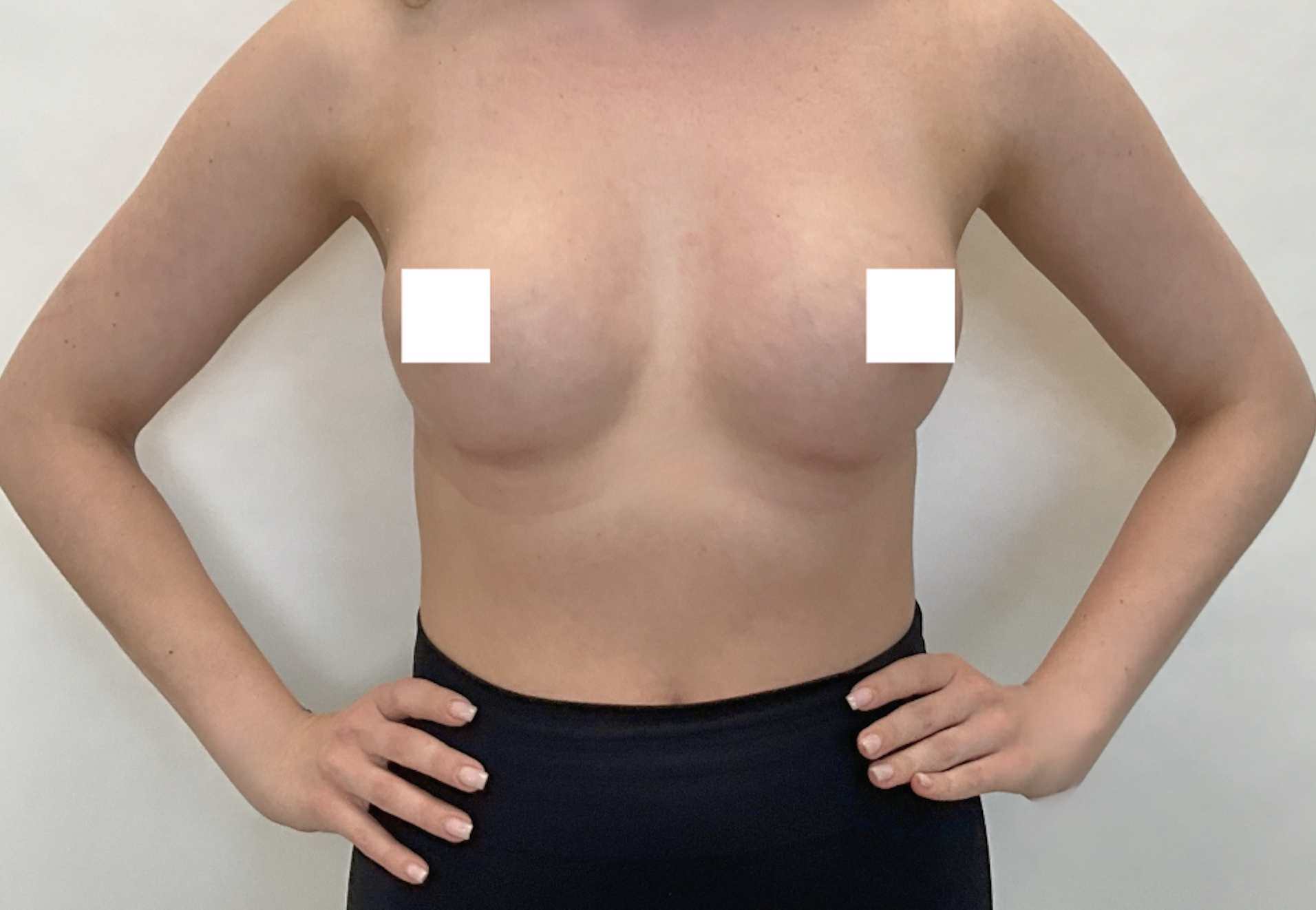 Po zabiegu – Powiększenie piersi implantami