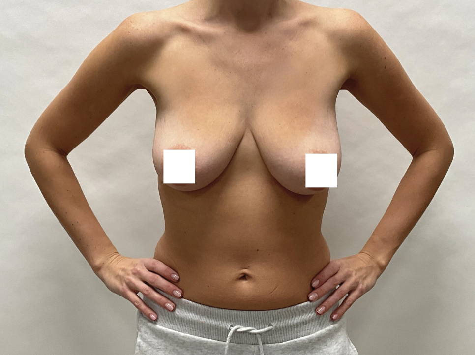 Przed zabiegiem – Mastopeksja z implantami
