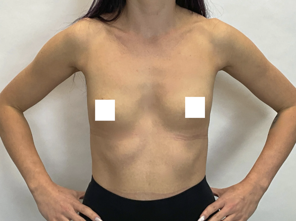 Przed zabiegiem – Powiększenie piersi implantami