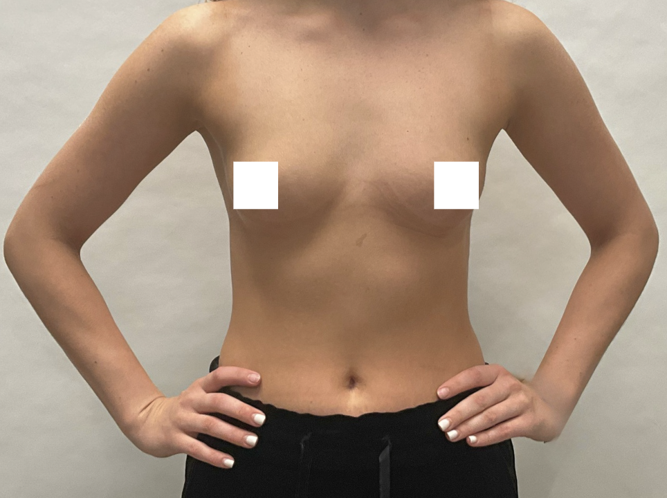 Przed zabiegiem – Powiększenie piersi implantami